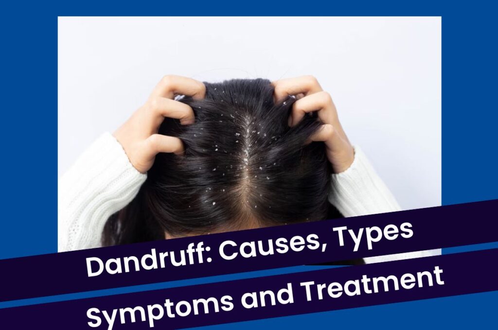 Dandruff: Causes, Types, Symptoms, and Treatment